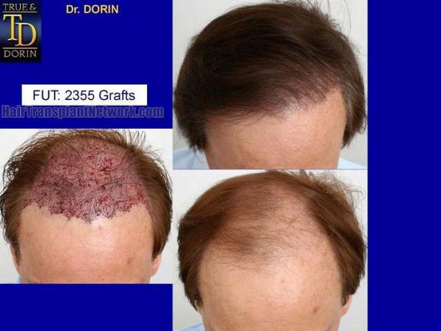 Hair transplant procedure before and postoperative images