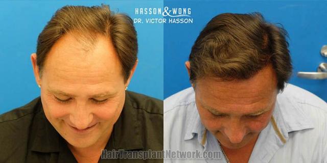 Hair restoration surgery before and after images