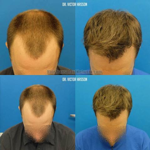 Top view before and after hair restoration results