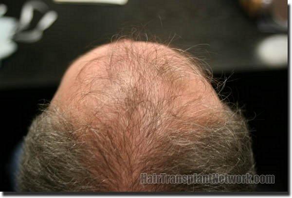 Hair restoration procedure results