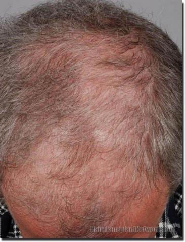 Hair restoration procedure results