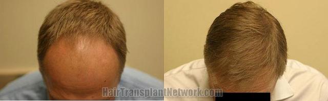 Top view - before and after hair restoration images