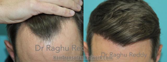 Top view - Before and after hair restoration results