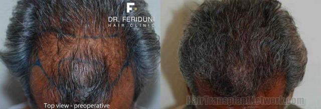 Hair restoration procedure before and postoperative pictures