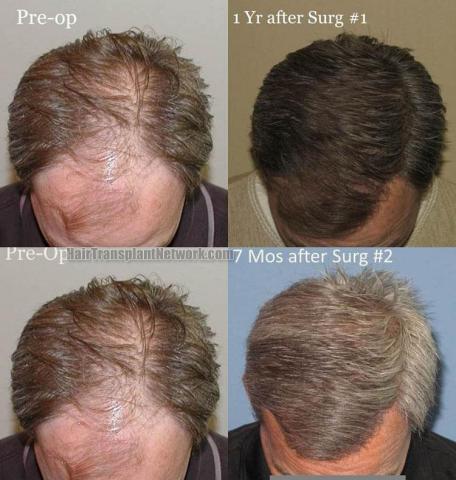 Hair restoration procedure before and after results