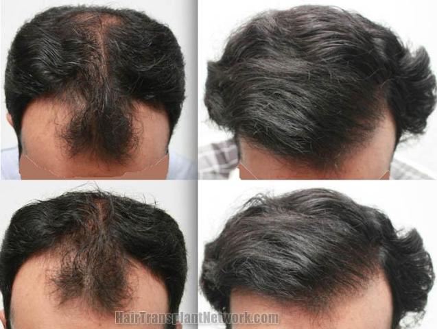 Hair transplantation surgery before and after photos