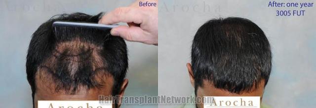 Hair transplantation surgery before and after photos