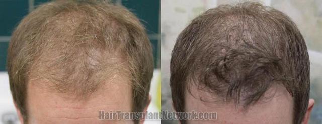 Hair restoration procedure before and after results