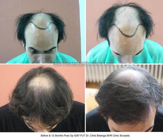 Hair transplantation surgery before and after images