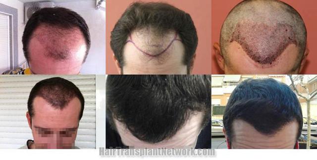 Hair restoration procedure before and after results