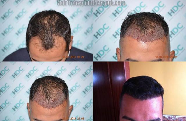 Hair transplantation surgery before and after photos