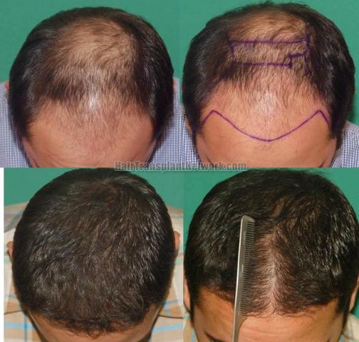 Top view before and after hair restoration results