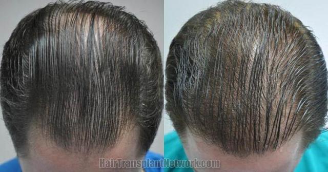 Hair restoration procedure before and after results