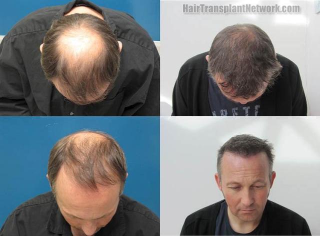 Hair restoration procedure before and after results