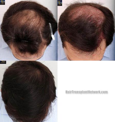 Hair restoration procedure before and after results