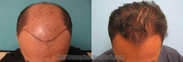 Hair transplantation surgery before and after images