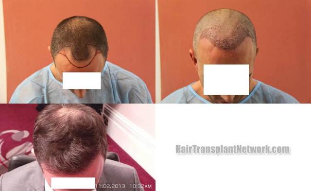 Top view - Before and after surgical hair replacement