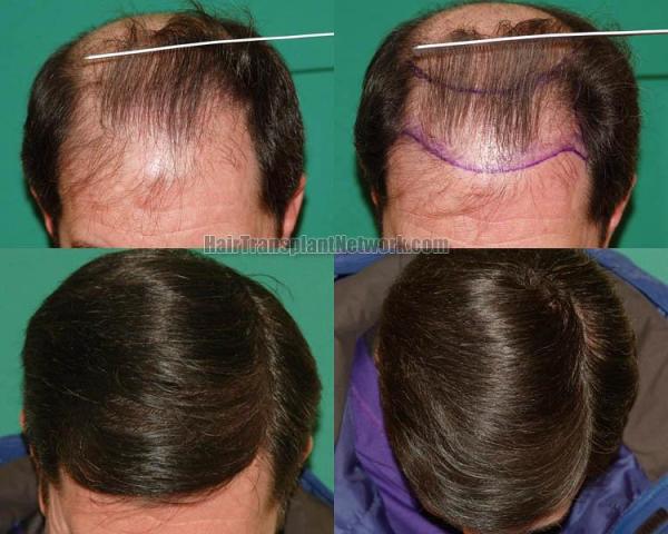 Before and after hair transplant procedure images