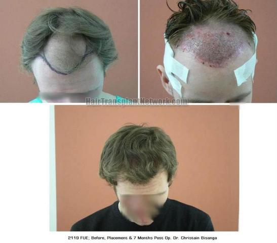 Top view before and after hair restoration results