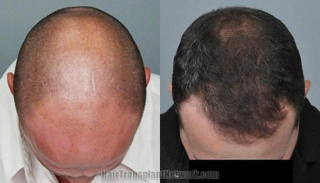 Hair transplantation surgery before and after photos