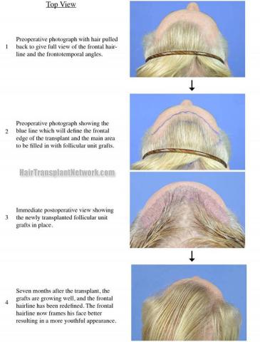 Hair transplantation surgery before and after photos