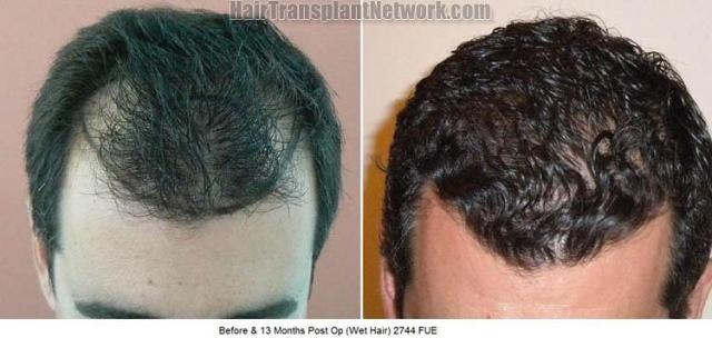 Hair transplantation surgery before and after photos