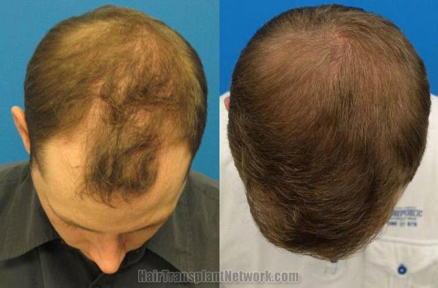 Top view - Before and after surgical hair replacement