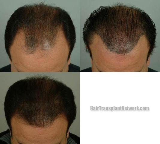 Hair transplantation surgery before and after photos