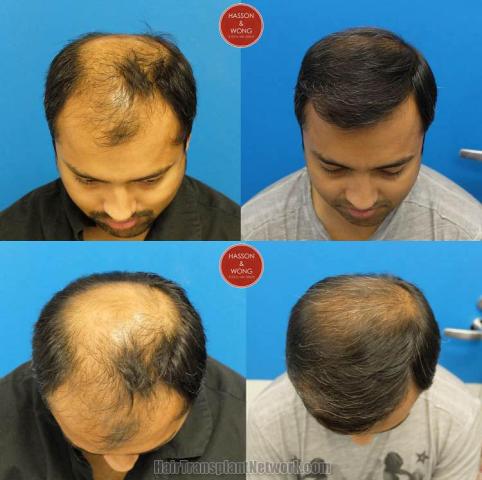 Hair transplantation surgery before and after photos