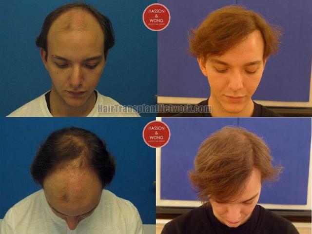 Top view before and after hair restoration results