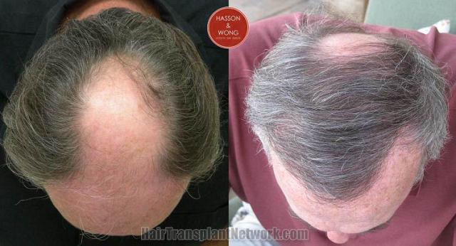 Hair transplantation surgery before and after photos