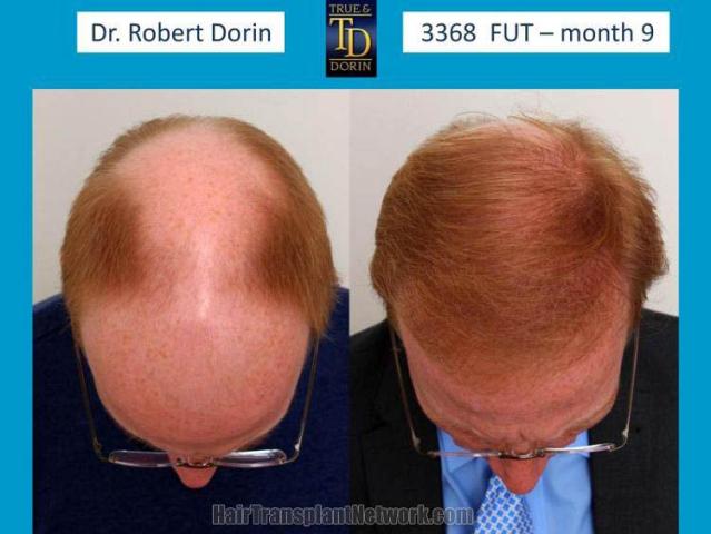 Hair restoration procedure before and after results