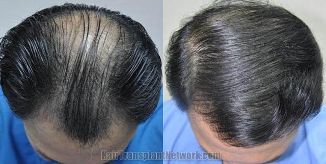 Top view - Before and after surgical hair replacement