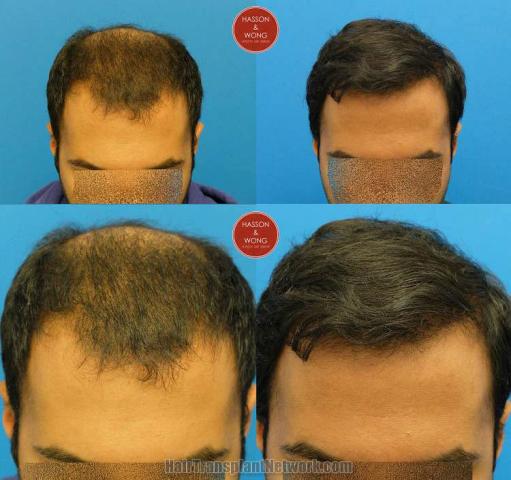 Hair transplantation surgery before and after photos