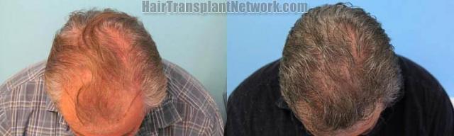 Hair transplantation surgery before and after images