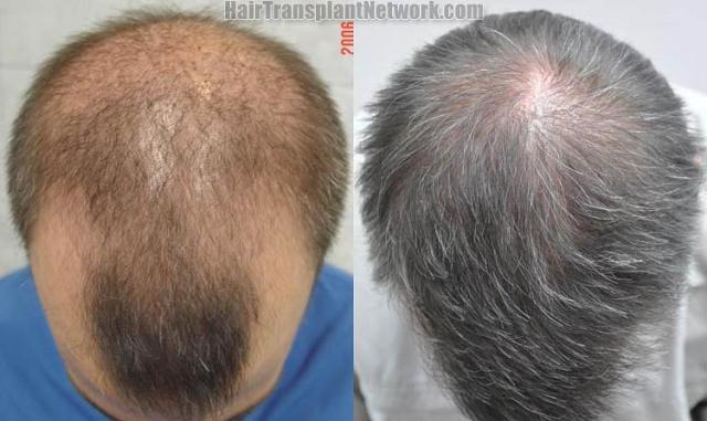 Top view before and after hair restoration results