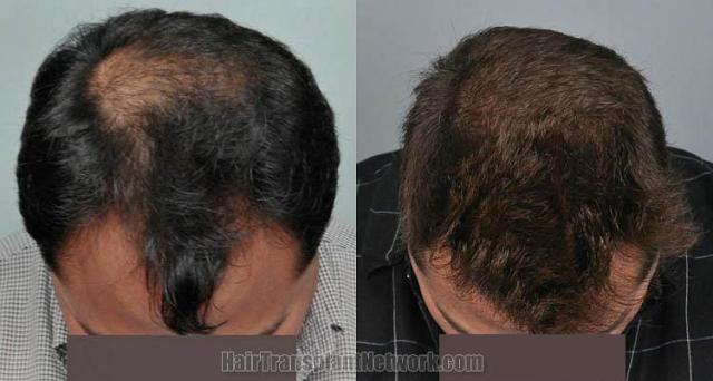 Hair transplantation surgery before and after images