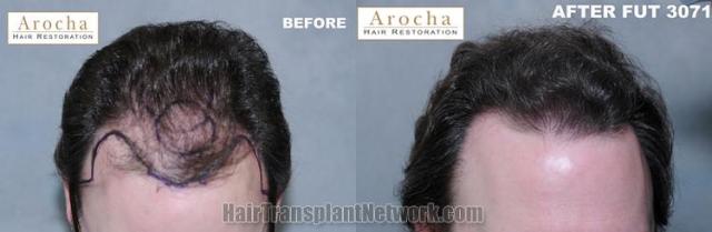 Hair transplantation surgery before and after photos