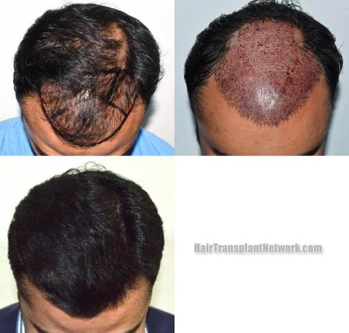 Hair restoration procedure before and after results