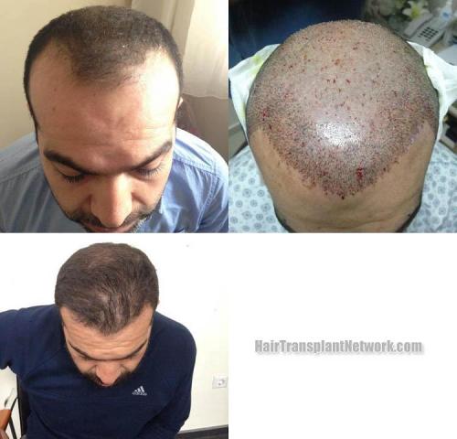 Top view - Before and after surgical hair replacement