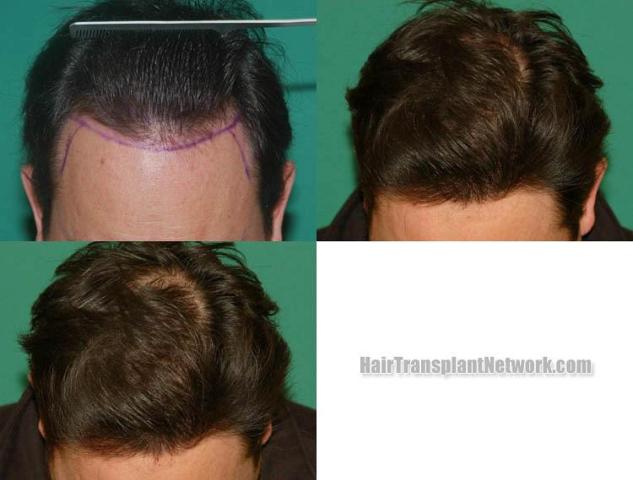 Top view before and after hair restoration results