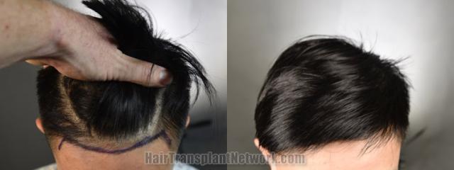 Top view - Before and after hair restoration results