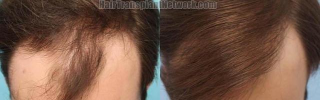 Hair transplantation surgery before and after photos