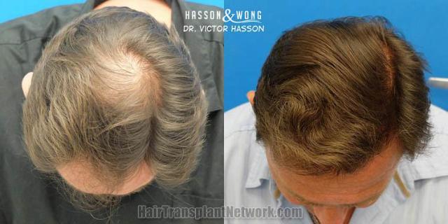 Hair transplantation surgery before and after photos