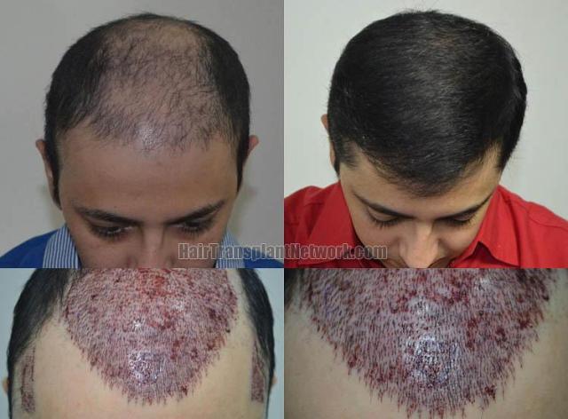 Hair transplantation surgery before and after photos