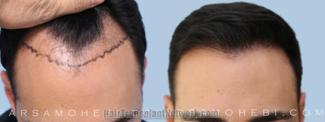 Top view - Before and after hair restoration results