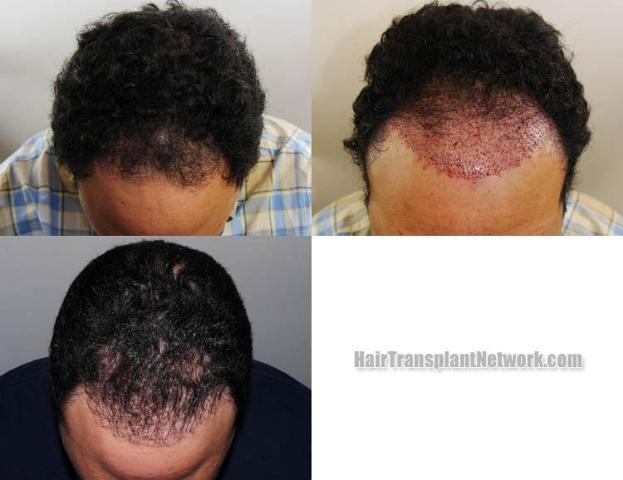 Before and after hair transplant procedure images