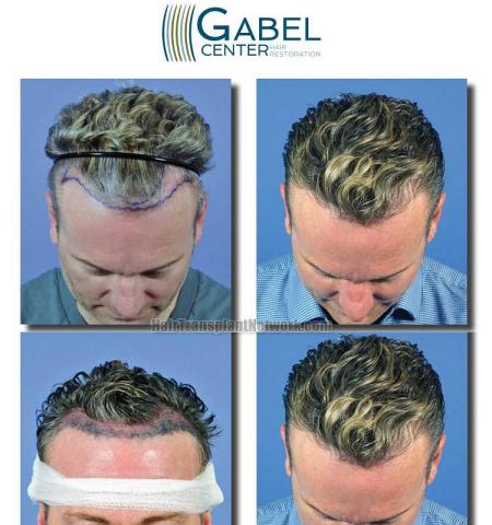 Hair restoration procedure before and after result photos