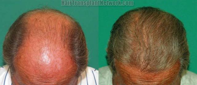 Hair restoration procedure before and after result photos