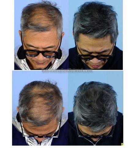 Hair transplantation surgery before and after photos